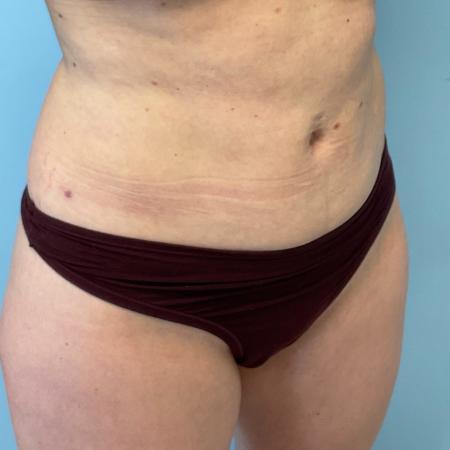 After image 2 Case #129341 - 40 y.o. female with liposuction of abs 