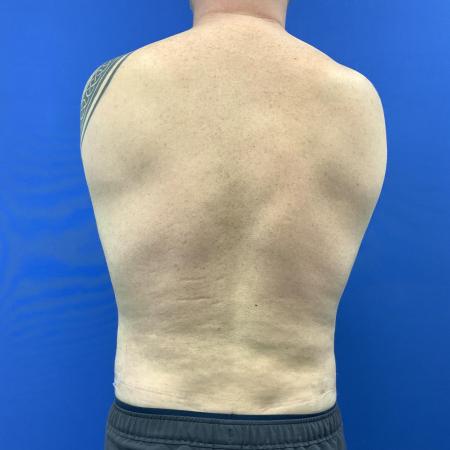 After image 4 Case #129431 - Liposuction