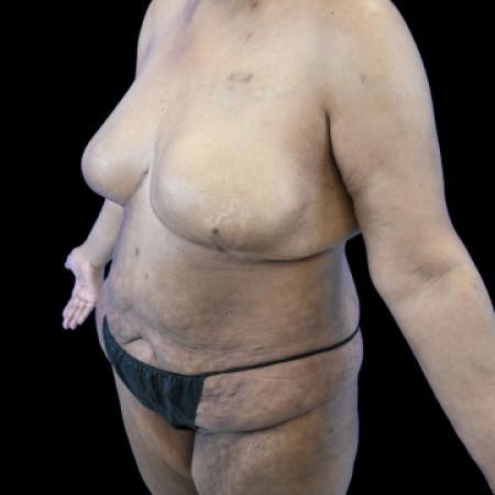 Before image 2 Case #129141 - Tummy Tuck