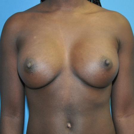After image 1 Case #130101 - Breast Augmentation