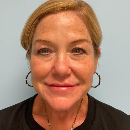 After image 1 Case #129991 - 58 y.o. female with Liquid Facelift