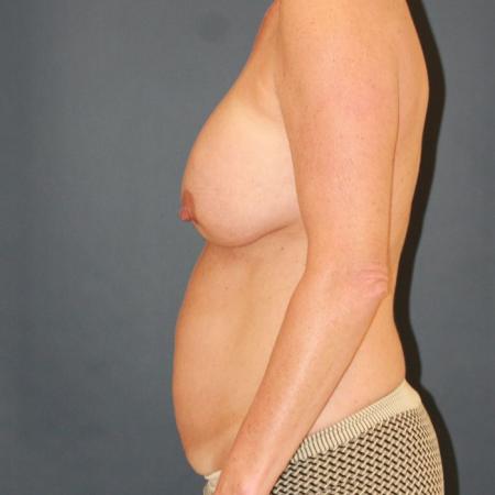 Before image 3 Case #129596 - Mommy Makeover