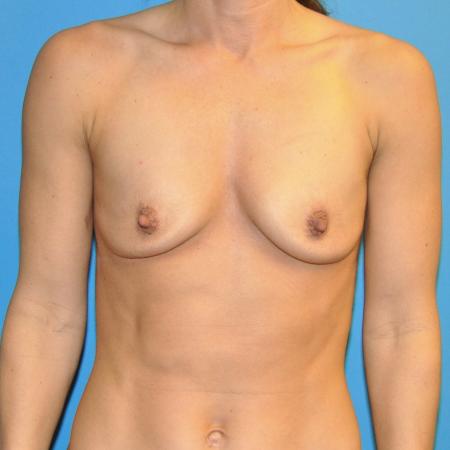 Before image 1 Case #130081 - Breast Augmentation