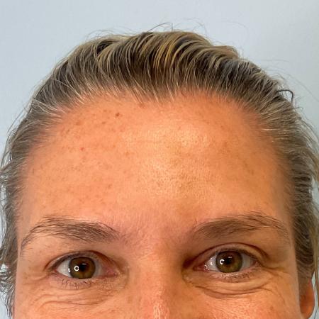 After image 3 Case #129801 - 47 y.o. female with Botox