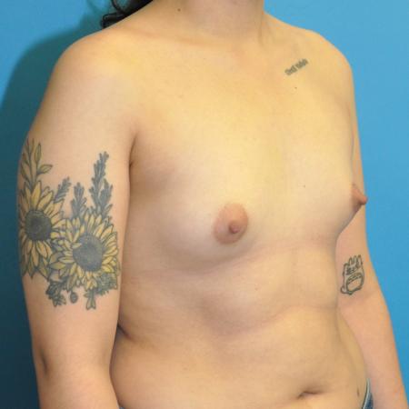 Before image 2 Case #130051 - Breast Augmentation, Motiva, "Dual Plane" Position