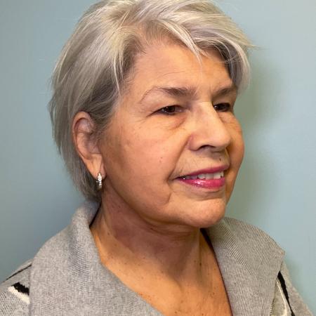 After image 2 Case #129511 - 75 y.o. female w/ Face & Neck Lift