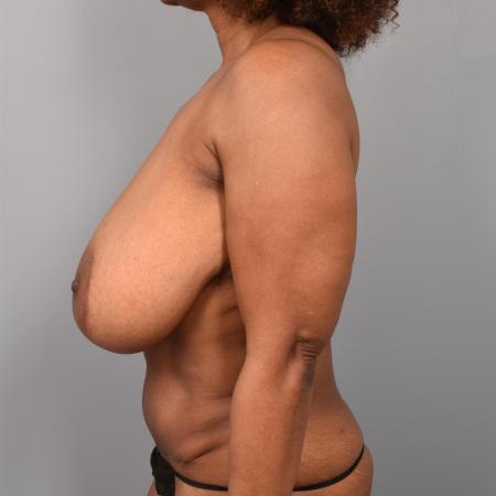 Before image 3 Case #129781 - Breast Reduction with Lift