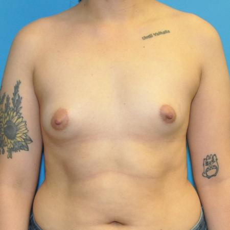 Before image 1 Case #130051 - Breast Augmentation, Motiva, "Dual Plane" Position