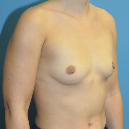 Before image 2 Case #130106 - Breast Augmentation 
