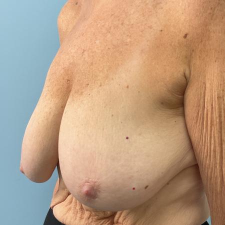 Before image 2 Case #129836 - 67 y.o. female with Breast Lift