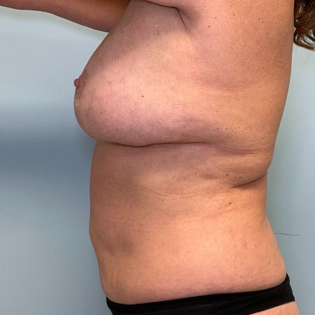 After image 3 Case #129681 - 55 y.o female with Mommy Makeover