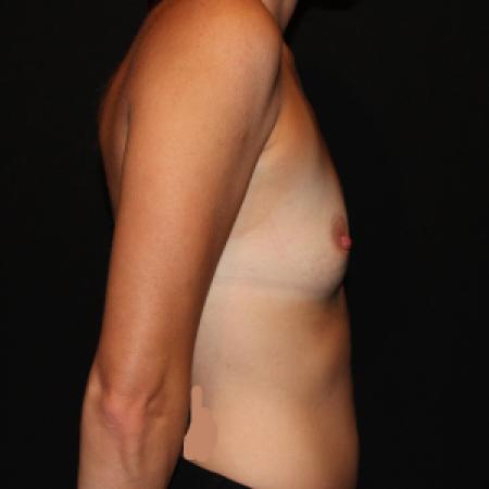 Before image 3 Case #129931 - Breast augmentation