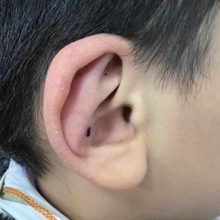 After image 2 Case #129846 - Ear Reshaping