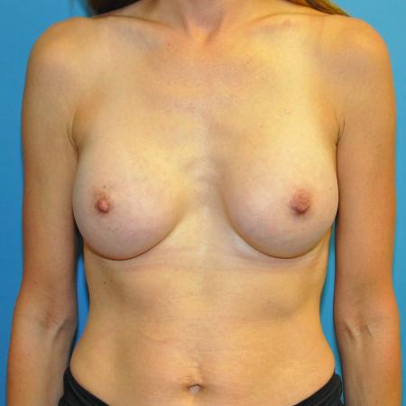 After image 1 Case #130066 - Breast Augmentation, "Dual Plane"
