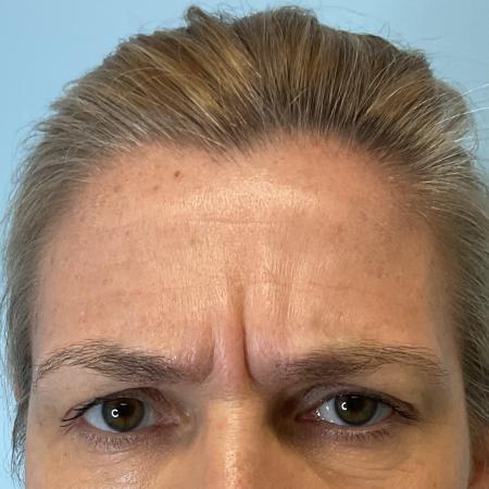 Before image 2 Case #129801 - 47 y.o. female with Botox