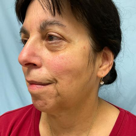Before image 2 Case #129811 - 66 y.o female with Face & Necklift w/ Fat Grafting