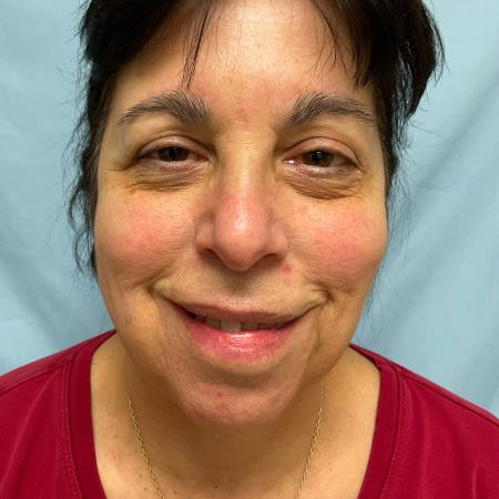 Before image 3 Case #129811 - 66 y.o female with Face & Necklift w/ Fat Grafting