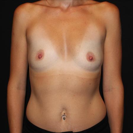 Before image 1 Case #129931 - Breast augmentation