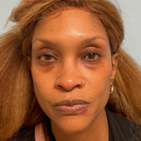 Before image 1 Case #129906 - 54 y.o. female w/ Lower Blepharoplasty