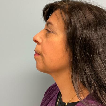 After image 1 Case #129811 - 66 y.o female with Face & Necklift w/ Fat Grafting