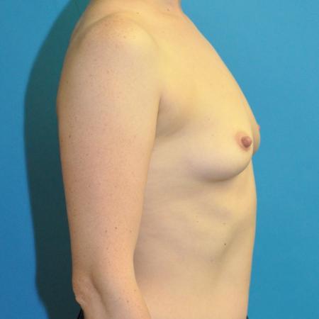 Before image 3 Case #130076 - Breast Augmentation
