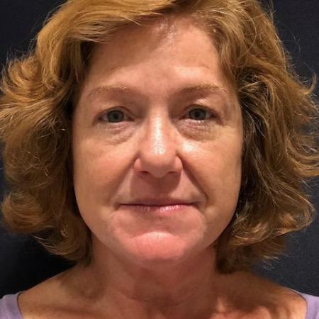 Before image 1 Case #129991 - 58 y.o. female with Liquid Facelift