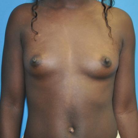 Before image 1 Case #130101 - Breast Augmentation