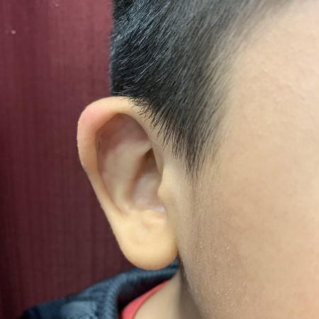 Before image 1 Case #129846 - Ear Reshaping