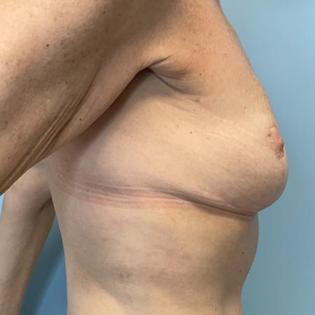 After image 3 Case #129836 - 67 y.o. female with Breast Lift