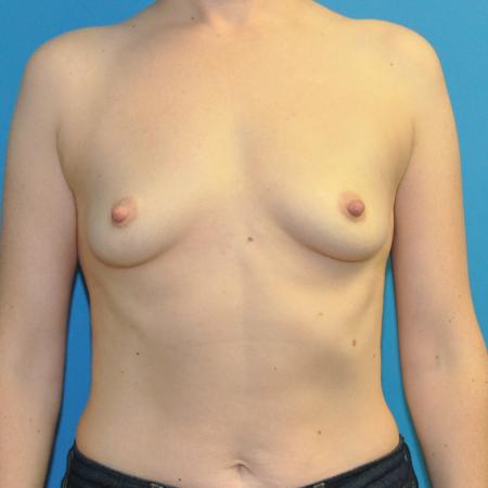 Before image 1 Case #130076 - Breast Augmentation