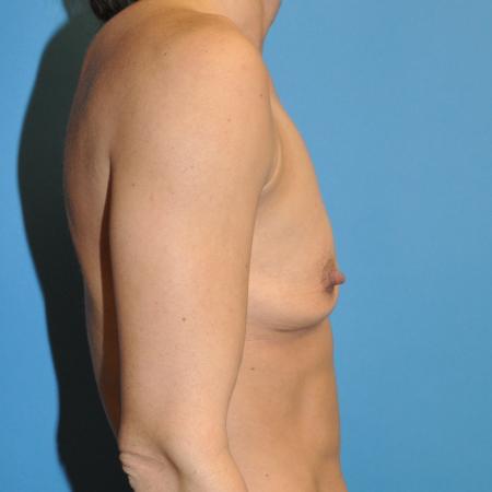 Before image 3 Case #130081 - Breast Augmentation