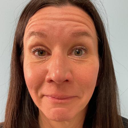 Before image 2 Case #129796 - 45 y.o. female with Botox