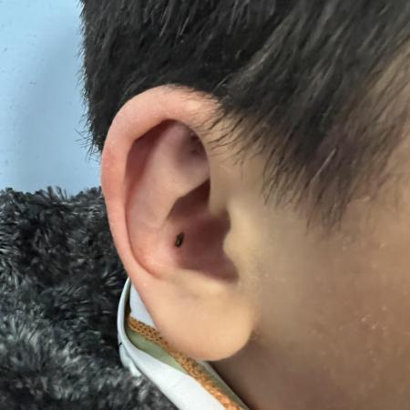 After image 1 Case #129846 - Ear Reshaping