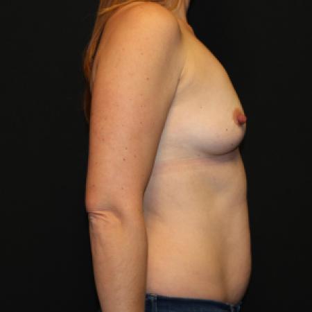 Before image 3 Case #129936 - Breast augmentation