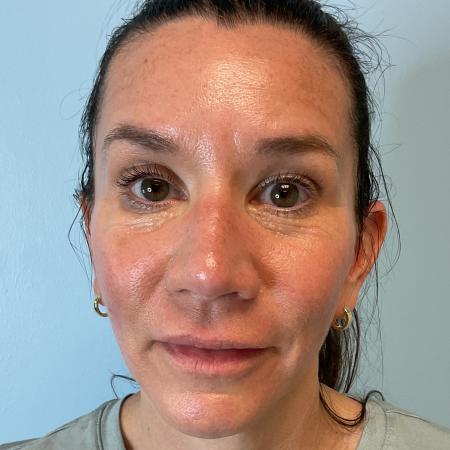 After image 2 Case #129796 - 45 y.o. female with Botox