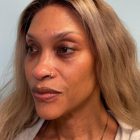 After image 2 Case #129906 - 54 y.o. female w/ Lower Blepharoplasty