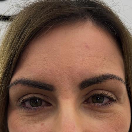 After image 1 Case #130021 - upper blepharoplasty