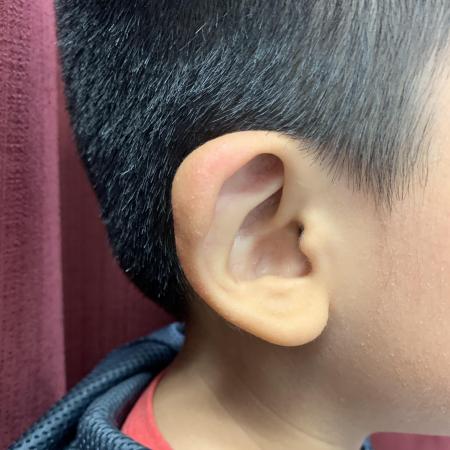 Before image 2 Case #129846 - Ear Reshaping