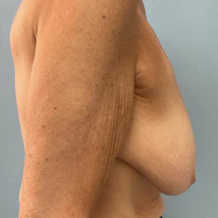 Before image 3 Case #129836 - 67 y.o. female with Breast Lift