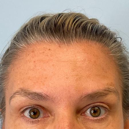 After image 1 Case #129801 - 47 y.o. female with Botox