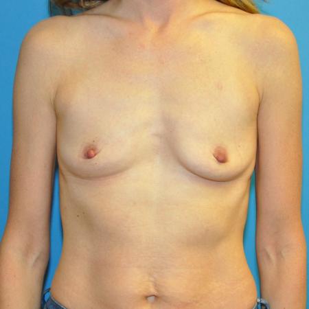 Before image 1 Case #130066 - Breast Augmentation, "Dual Plane"