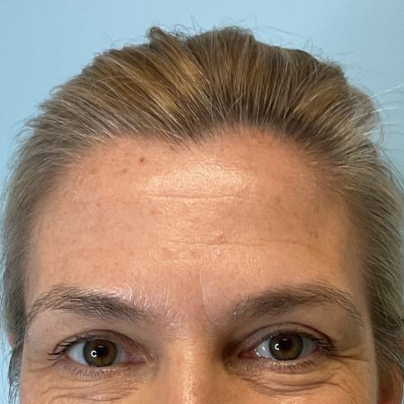 Before image 3 Case #129801 - 47 y.o. female with Botox