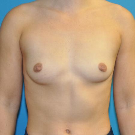 Before image 1 Case #130106 - Breast Augmentation 