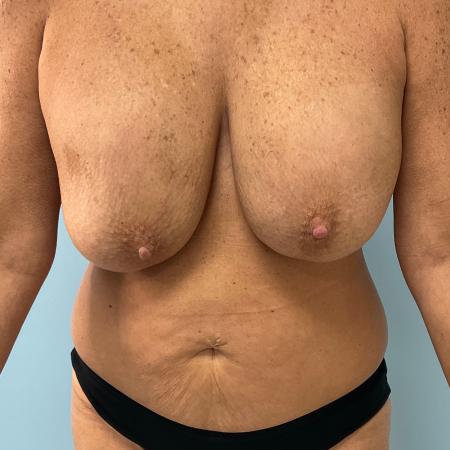 Before image 1 Case #129681 - 55 y.o female with Mommy Makeover
