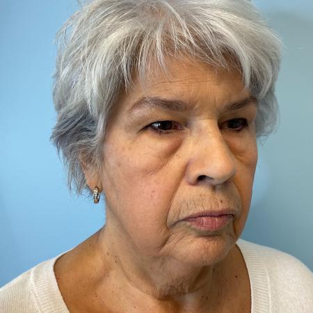 Before image 2 Case #129511 - 75 y.o. female w/ Face & Neck Lift