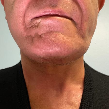 After image 3 Case #129916 - 64 y.o. male with Face and Necklift