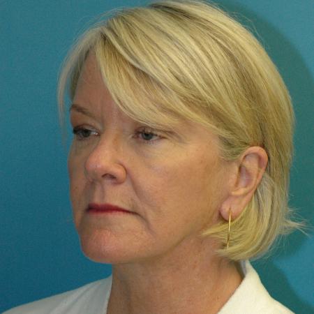 After image 2 Case #130336 - Face and Necklift