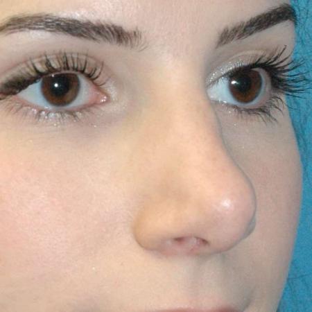 After image 3 Case #130161 - Primary Rhinoplasty