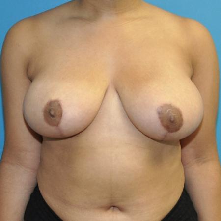 After image 1 Case #130266 - Breast Reduction