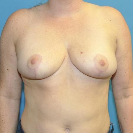 After image 1 Case #130281 - Breast Reduction and Bra Roll Liposuction